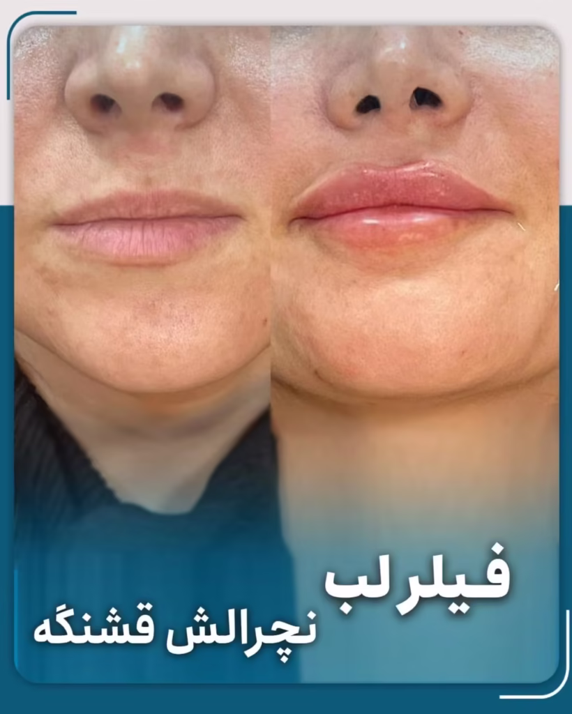عکس قبل و بعد فیلر لب مدل نچرال
