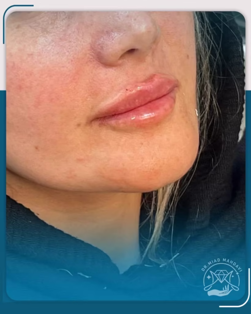 عکس قبل و بعد فیلر لب مدل نچرال