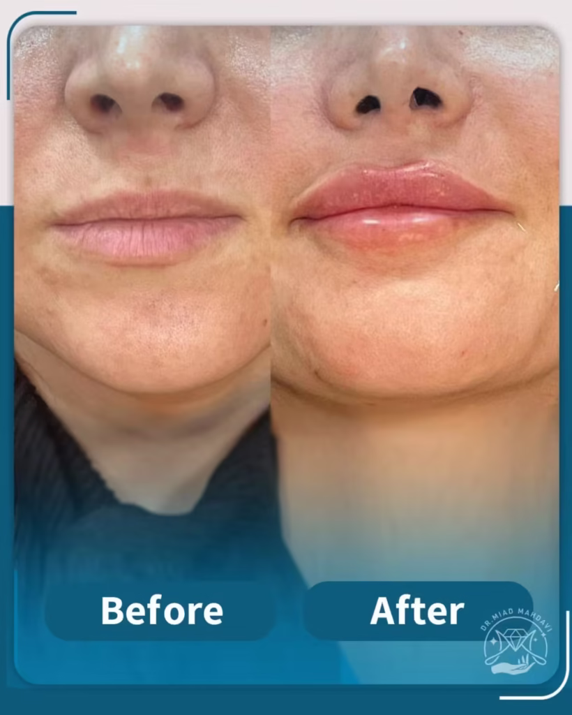 عکس قبل و بعد فیلر لب مدل نچرال