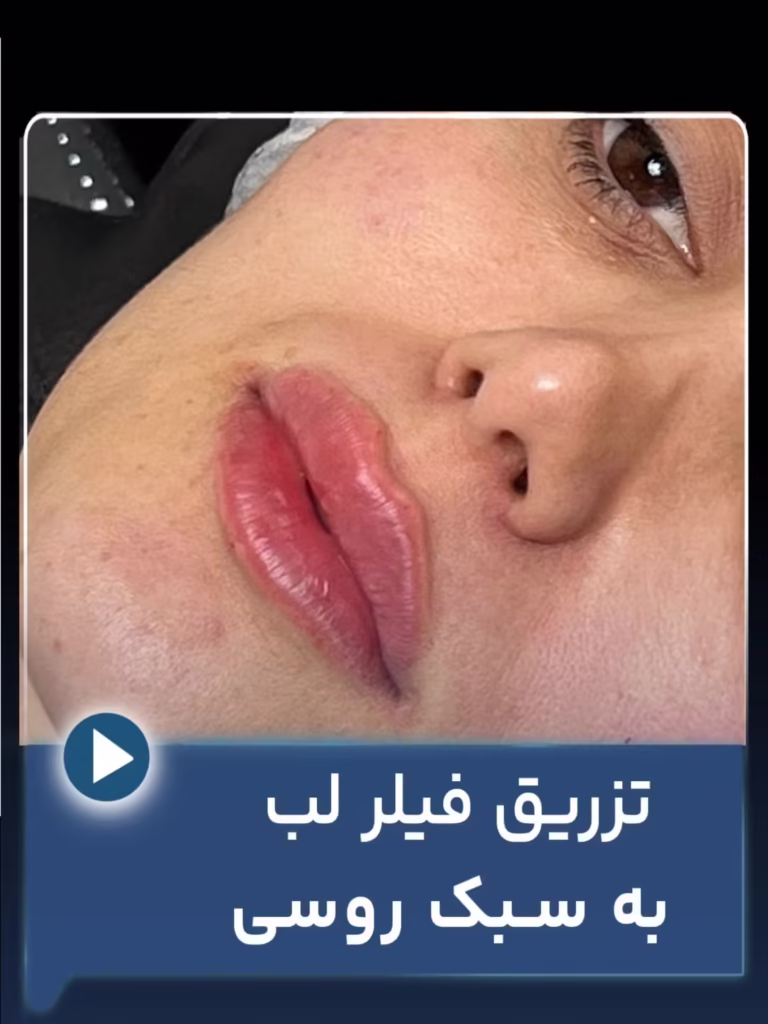 عکس قبل و بعد تزریق فیلر لب به سبک روسی 1 عکس قبل و بعد تزریق فیلر لب به سبک روسی