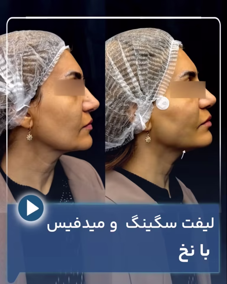 عکس قبل و بعد لیفت سگینگ و میدفیس با نخ