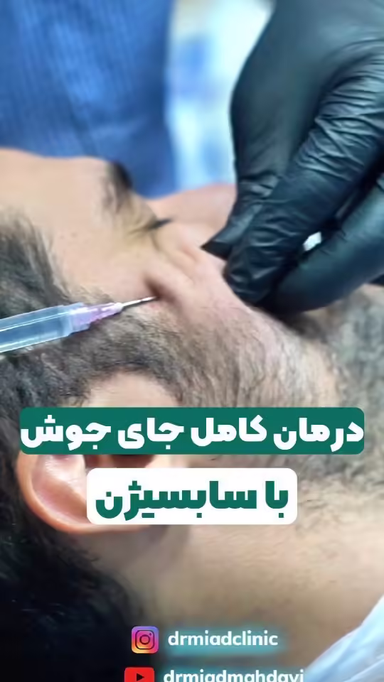 راهنمای جامع درمان قطعی اسکار آکنه: از رویا تا واقعیت پوست صاف
